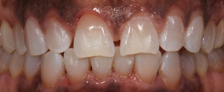 After Cleaning and Whitening