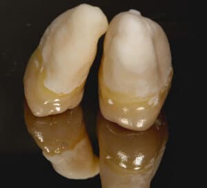 Wisdom Tooth Extraction